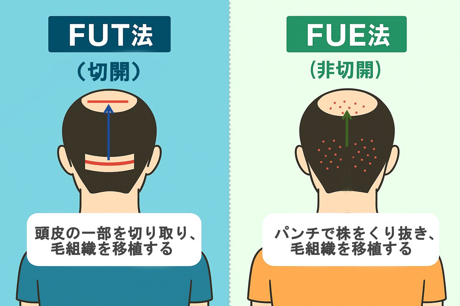 FUEとFUTの比較図(採取方法・傷跡・向いている人)
