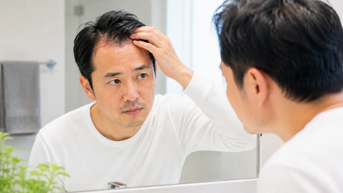 植毛手術後のダウンタイムを気にする男性